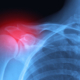 Repetitive Motion Injuries in Linemen: Carpal Tunnel, Tendinitis, and Legal Recourse